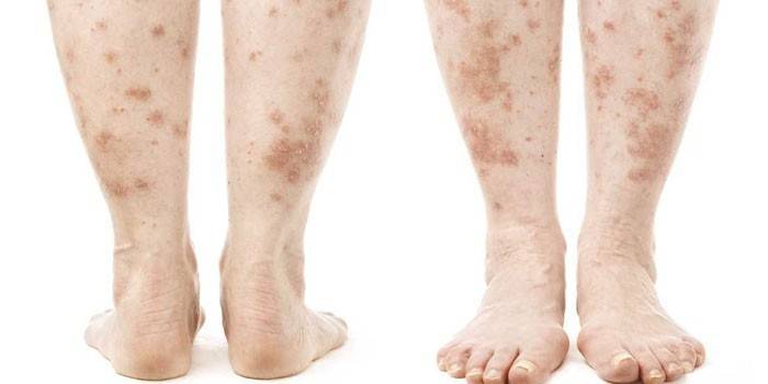 Psoriasis en las piernas.