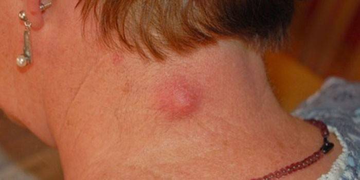 Ateroma en el cuello