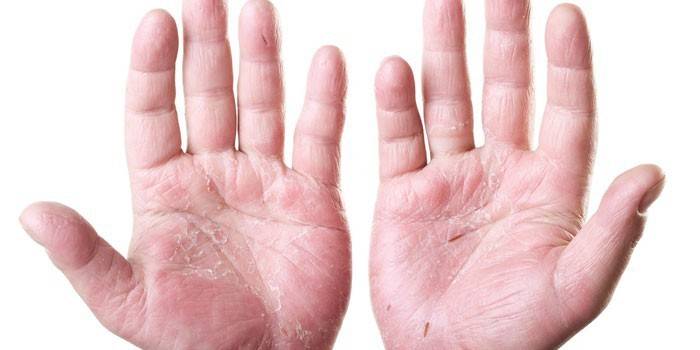 Dermatite nas palmas das mãos