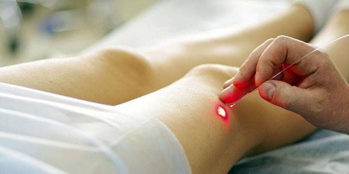 Laserové odstránenie aterómu na nohe pacienta