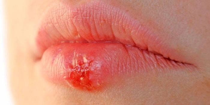 Herpes no lábio