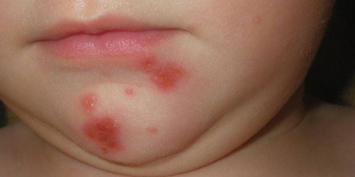 Streptoderma na twarzy dziecka