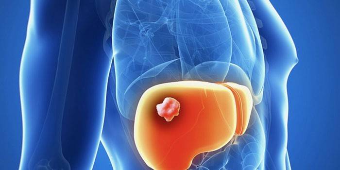 Tumor no fígado em humanos