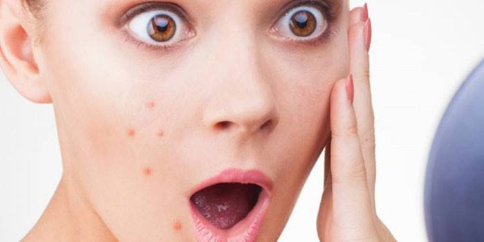 A garota tem acne no rosto