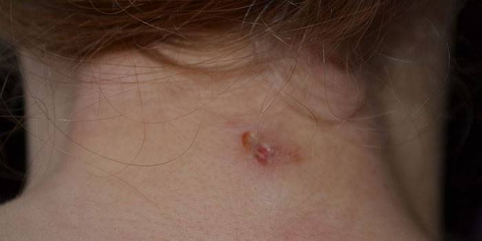 Cicatriz del cuello