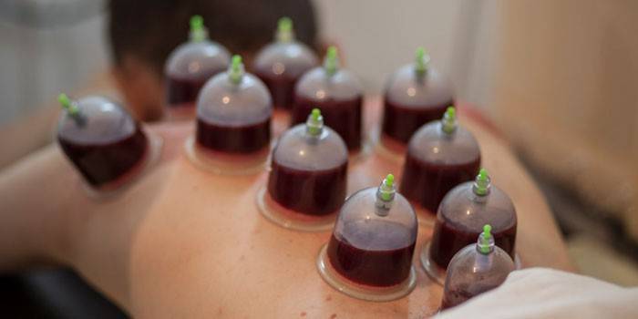 Um homem está fazendo um procedimento hijama com bancos