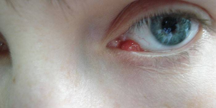 Cyst Moll