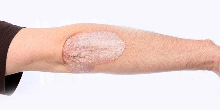 Psoriasis en el codo en un hombre.