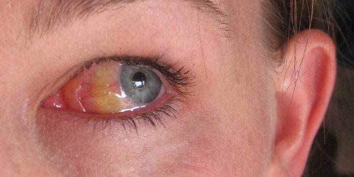 Esclera amarillenta de los ojos.