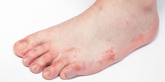 Dermatitída na chodidle