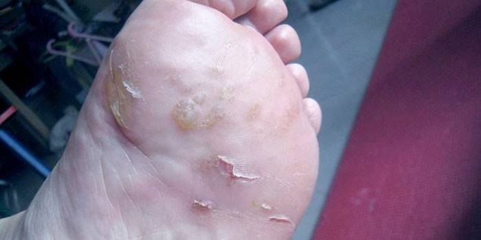 Dyshidrosis na stopie