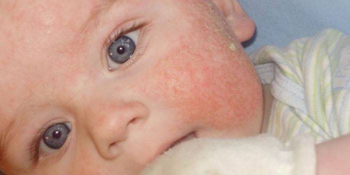 Alergia nas bochechas de bebês