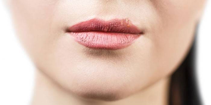 A manifestação de herpes no lábio
