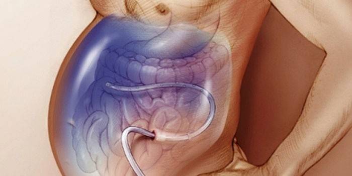 Líquido libre en el abdomen