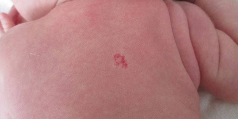 Hemangioma no corpo do bebê