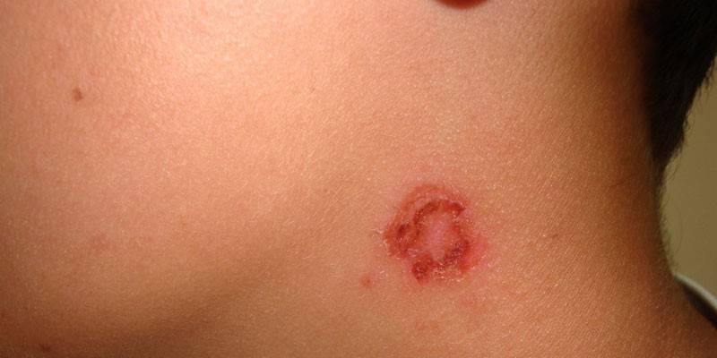 Impetigo estreptocócica