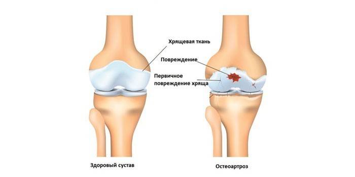 Zdravé koleno a osteoartróza