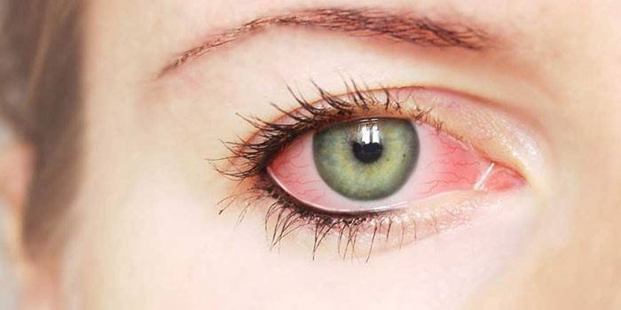 Enrojecimiento vascular de la proteína ocular.