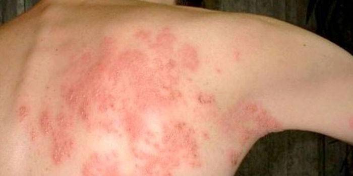 Prejav dermatomykózy kože na chrbte u ľudí