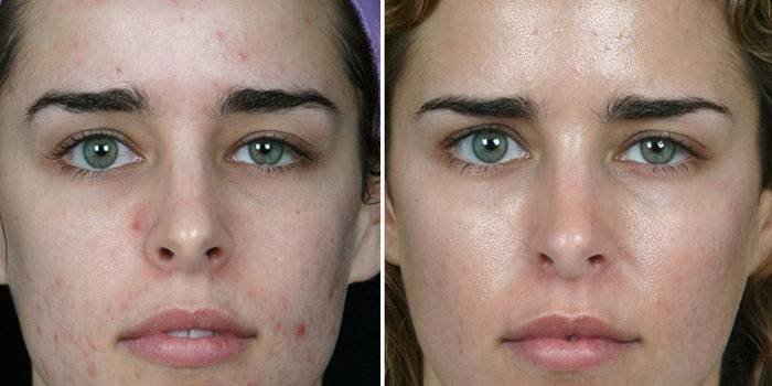 Pele no rosto da menina antes e depois da limpeza mecânica por um cosmetologista