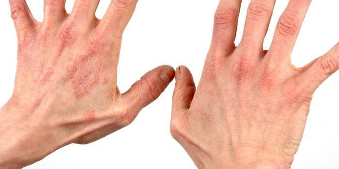 Prejavy dermatitídy na pokožke rúk