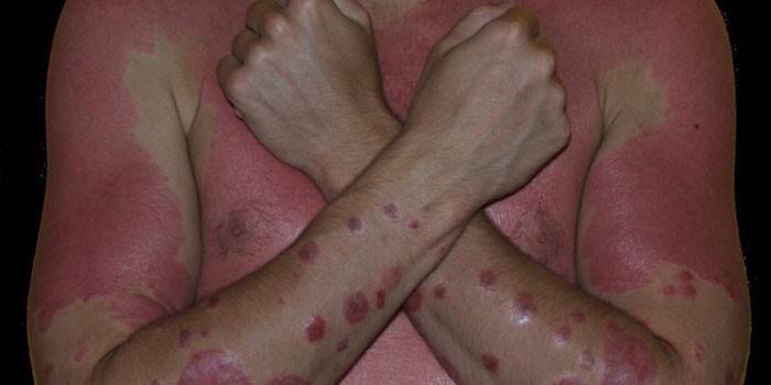 Eritrodermia psoriásica na pele humana