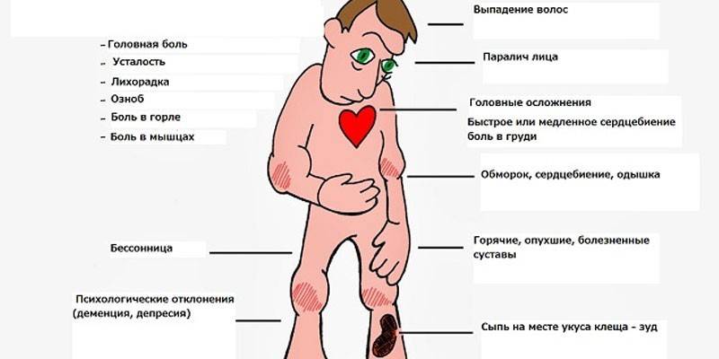 Objawy boreliozy