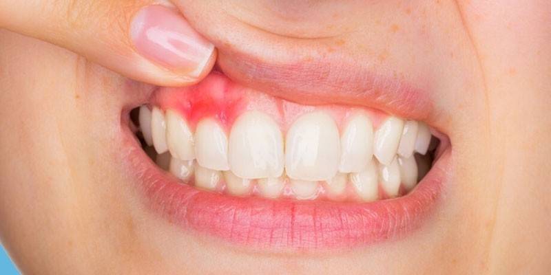 Gingivitída