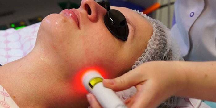 Laserová biorevitalizácia