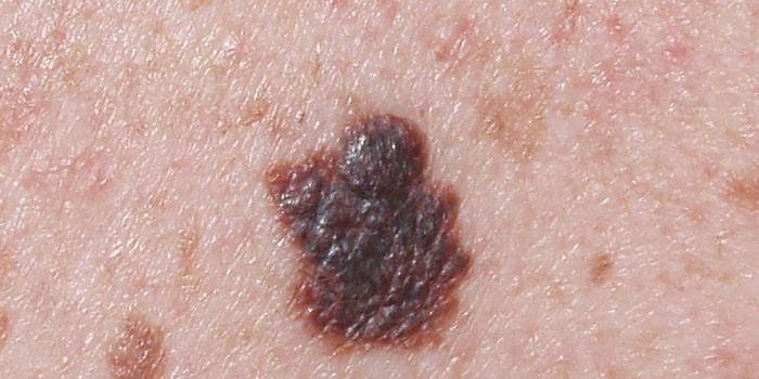 Melanoma na pele