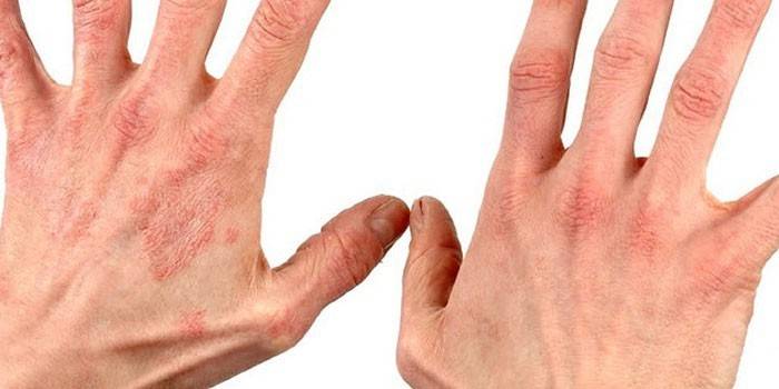Eczema seco nas mãos