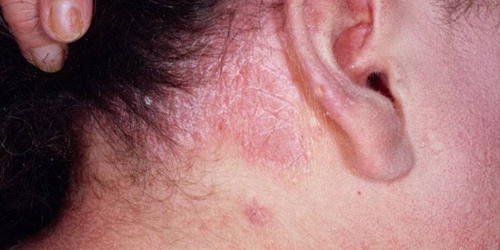 Dermatitis seborreica en el cuero cabelludo de una mujer.
