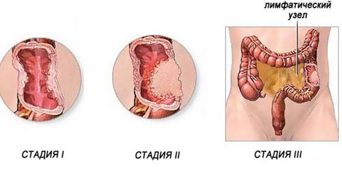 Etapas del cáncer de colon.
