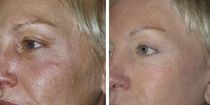 Foto de una mujer antes y después de la biorevitalización.