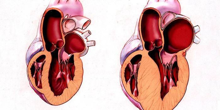 Esquema de un corazón sano y enfermo.