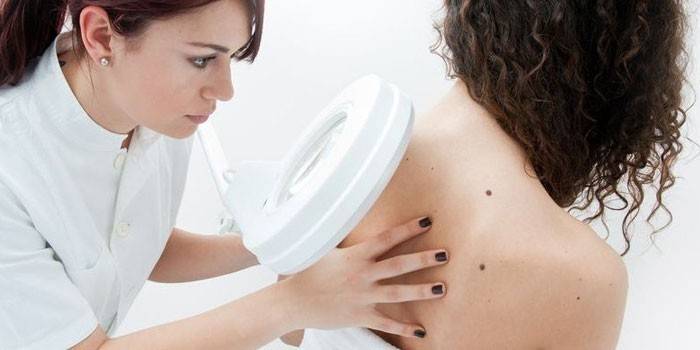 Um médico examina uma verruga nas costas de uma mulher