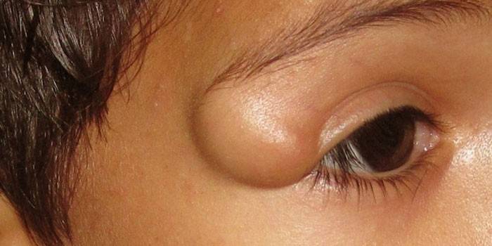 Lipoma no olho