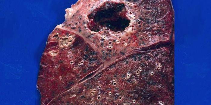 Absceso pulmonar