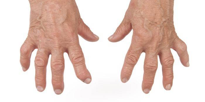 Artritis reumatoide de los dedos.