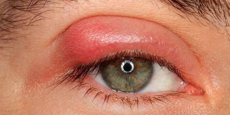 Hervir en el ojo