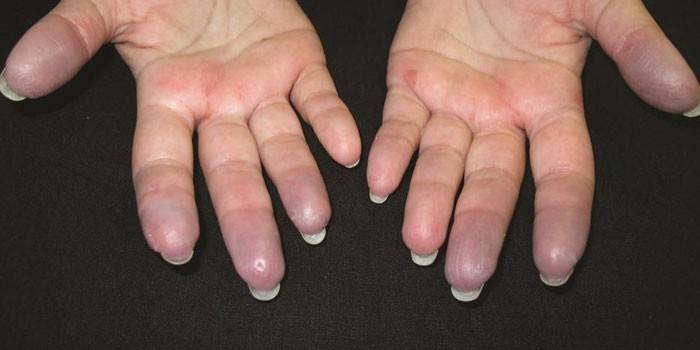 Alergia al dedo frío