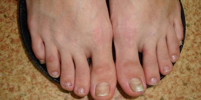 Onicomicosis de los pies