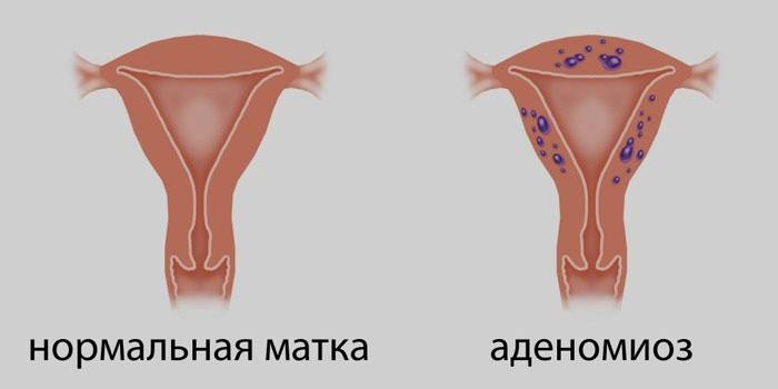 Útero normal e útero com adenomiose
