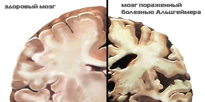 Porovnanie zdravého mozgu a mozgu postihnutého Alzheimerovou chorobou