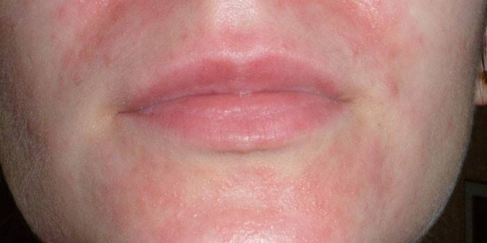 Enrojecimiento facial