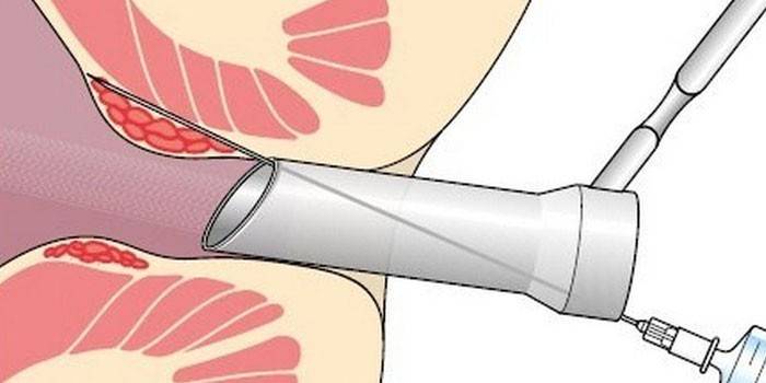 Escleroterapia para hemorróidas