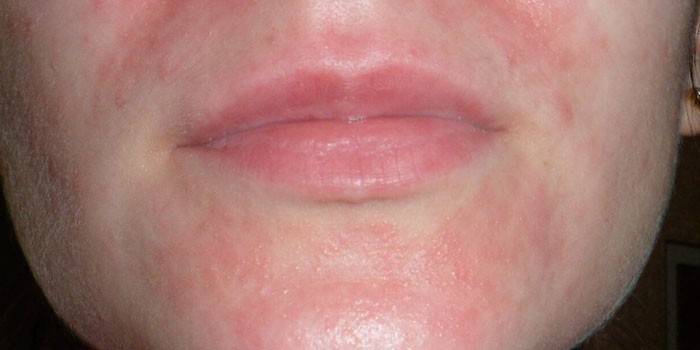 Enrojecimiento facial