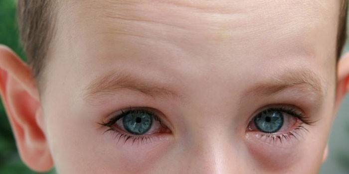 Inchaço dos olhos em uma criança
