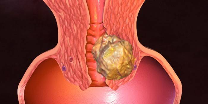 Câncer cervical
