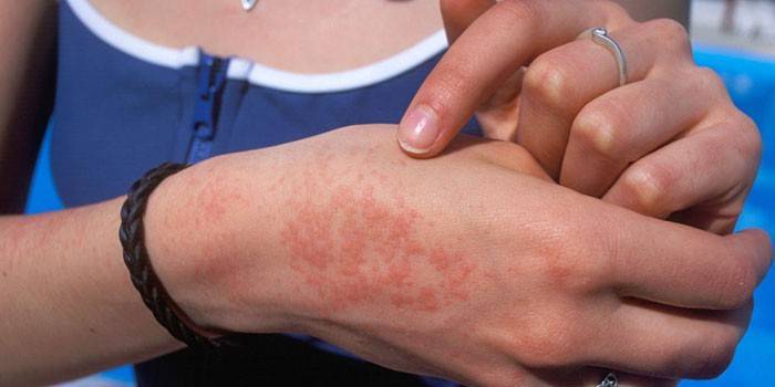 Prejav alergickej vyrážky na pokožke ruky